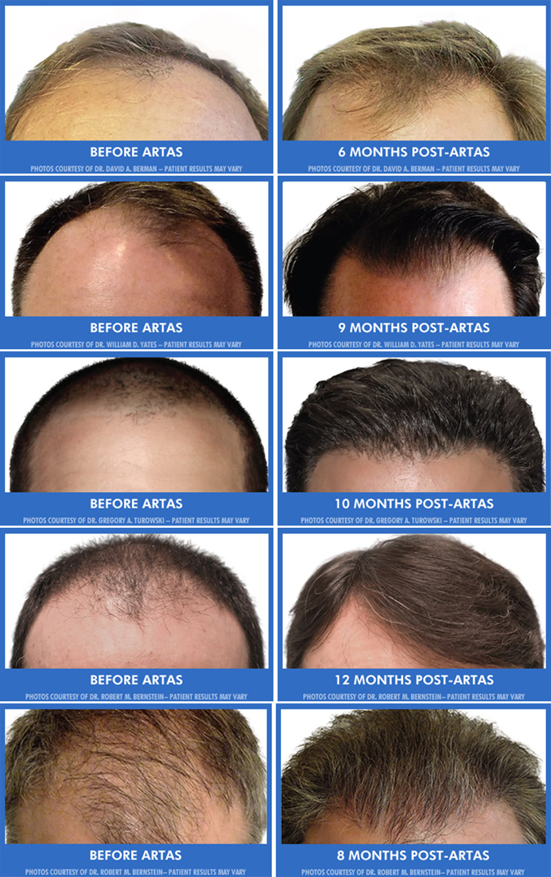 ARTAS Hair Transplant The Woodlands