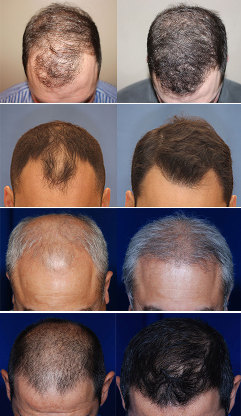 NeoGraft The Woodlands